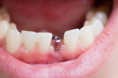 dental implants mooloolah qld