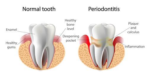 periodontal treatment mooloolah qld