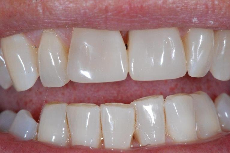 Cosmetic-Dentistry-After-Image