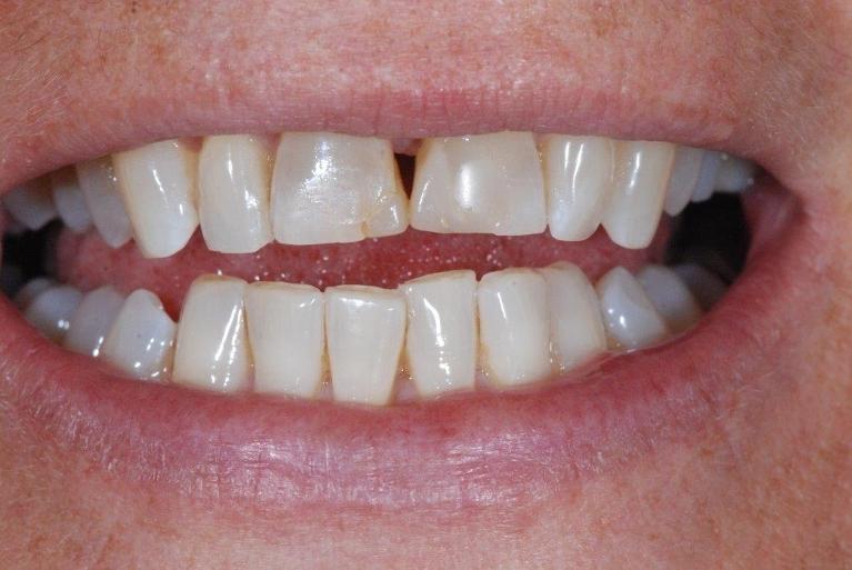 Cosmetic-Dentistry-Before-Image