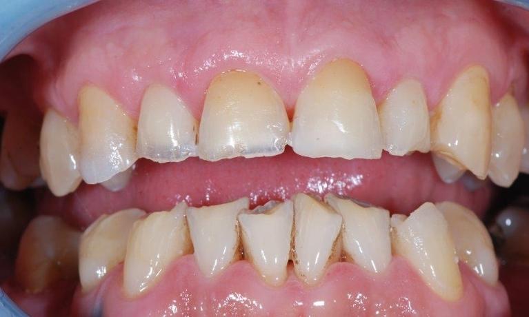 Dental-Bonding-Before-Image